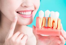 Implante dentário: quais os principais cuidados?