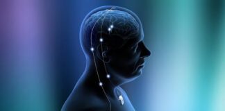 Como funciona a cirurgia de estimulação cerebral profunda para epilepsia