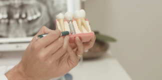 Especialista explica e aponta vantagens do tratamento com implantes dentários