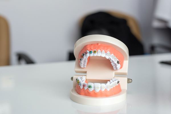 Problemas de oclusão dentária atingem mais da metade das crianças Problemas de oclusão dentária atingem mais da metade das crianças