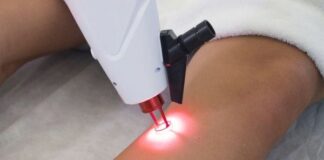 Tratamento de vasinhos com laser transdérmico